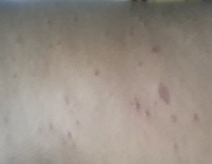 Skin Infection Psoarisis