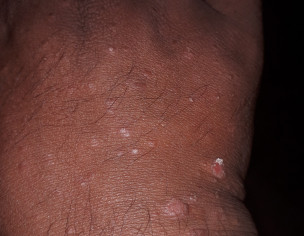 Skin Infection Psoarisis