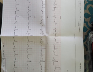 ECG Findings RBBB
