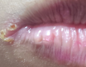 Angular Cheilitis