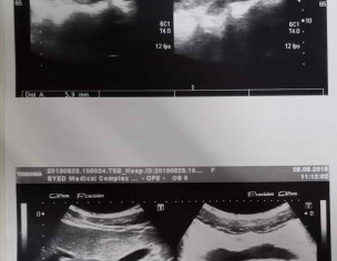 Past Typhoid  Treatment Done Now Severe Stomach Problem