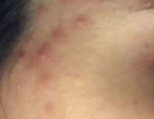 Acne Problem 