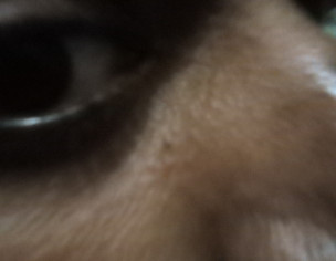 Blurred Vision Perhaps Diabetic Retinopathy