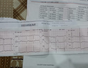Left Side Chest Discomfort
