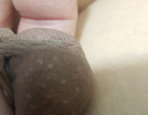 White Spot On Penis, Crown And Sock