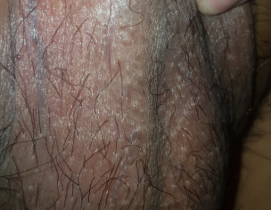 White Spot On Penis, Crown And Sock