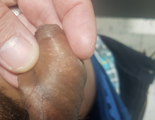 White Spot On Penis, Crown And Sock