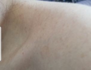 Tiny Spots On Body