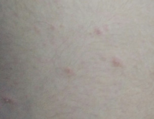 Pimple On Body