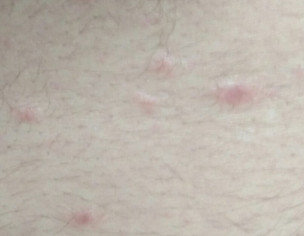 Pimple On Body