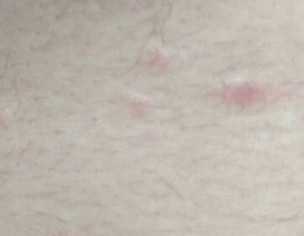 Pimple On Body
