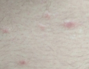 Pimple On Body