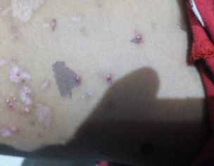 Skin Issue, (Pox, Danay)