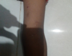 Skin Issue, (Pox, Danay)