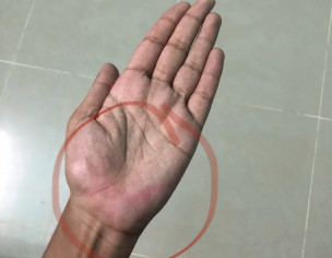 Reddish/pinkish Bruising On Palms