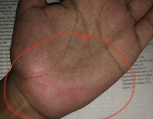 Reddish/pinkish Bruising On Palms