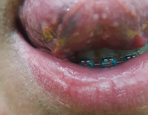 Some White Spot Inside My Cheeks, And Bumps Under My Tongue