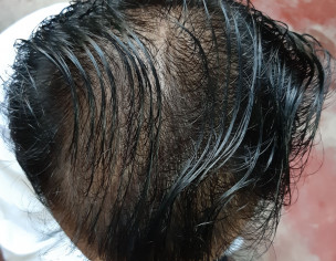 Male Patern Baldness (Alopecia)