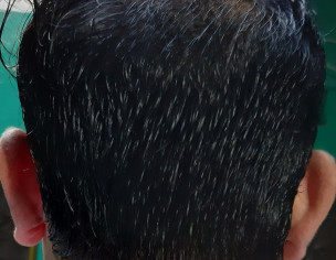 Male Patern Baldness (Alopecia)