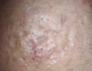 Acne Scar And Acne Vulgaris