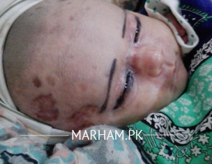 Dark Marks Newbornâ€™s Head