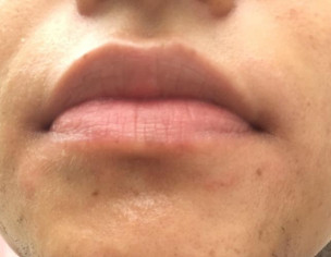 Skin Rash Around Mouth Which Is Very Itchy At Times