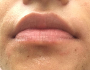 Skin Rash Around Mouth Which Is Very Itchy At Times