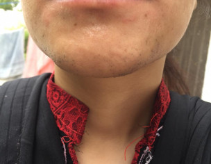 Skin Rash Around Mouth Which Is Very Itchy At Times