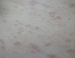 Red Patches, Pimple On Body