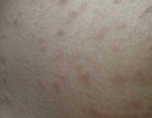 Red Patches, Pimple On Body