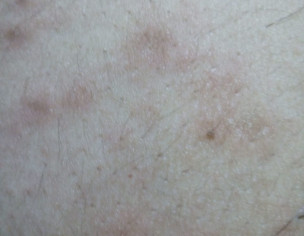 Red Patches, Pimple On Body