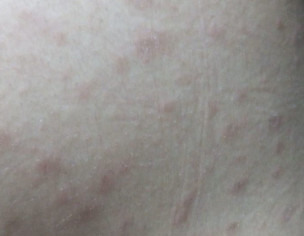 Red Patches, Pimple On Body