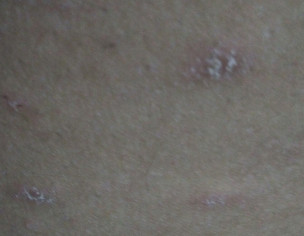 Red Patches, Pimple On Body