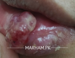 Blister Inside Lower Lip Became Worse
