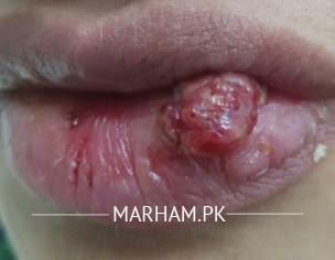 Blister Inside Lower Lip Became Worse