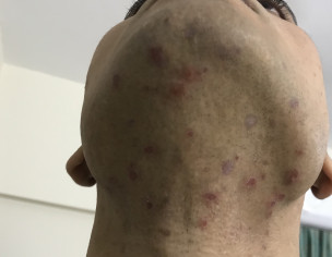 Red Spots On Beared Area