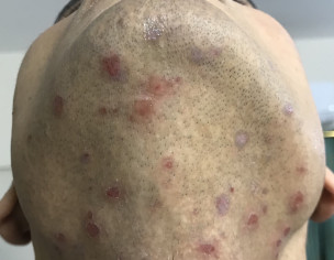 Red Spots On Beared Area