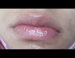 Itchy Lip Line