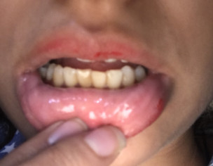 Teeth Pain &amp; Yellowing