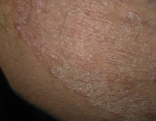 Fungal Circles Around  Private Part