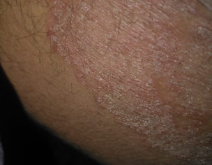 Fungal Circles Around  Private Part