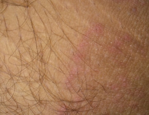 Fungal Circles Around  Private Part