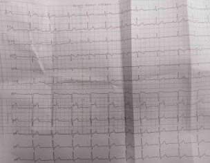 Retrosternal Pain Chest