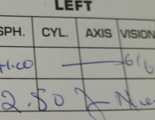 Cataract Eye Surgery