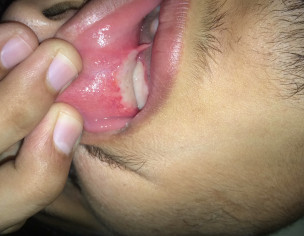 Teeth Pain And Swelling 