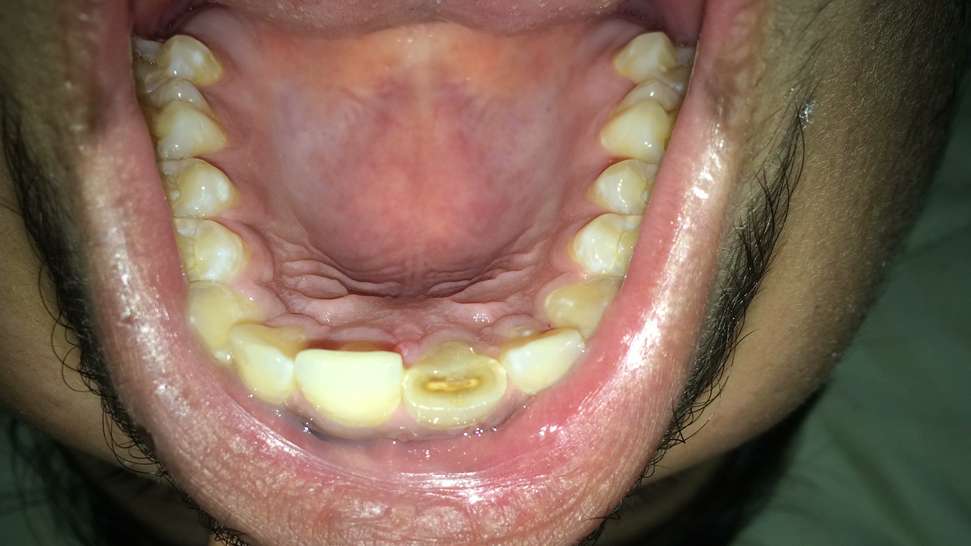 Ask a Dentist Online for Teeth Pain And Swelling