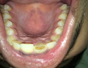 Teeth Pain And Swelling 