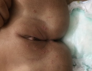 Small Pimples On Urine Area