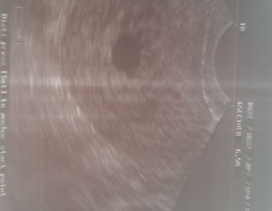 Pregnancy With No Heart Beat 