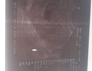 Pregnancy With No Heart Beat 